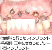 他歯科で行った、インプラント手術例。正中にささったブレード型インプラント。