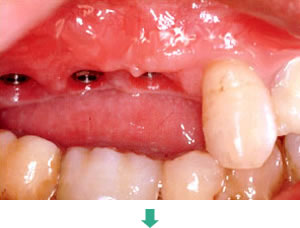 インプラント治療前