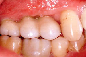 インプラント治療後