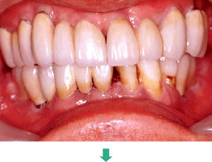 インプラント治療後:正面観