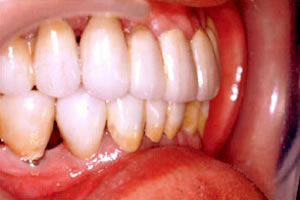 インプラント治療後