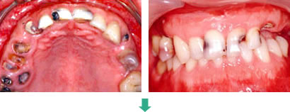 インプラント治療前