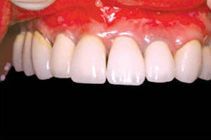 インプラント治療後