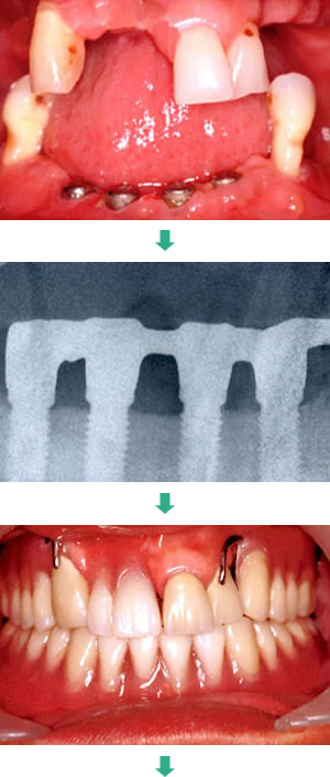 インプラント治療前
