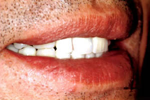 インプラント治療後