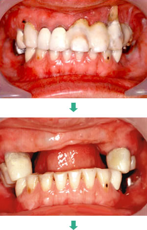 インプラント治療前