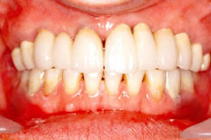 インプラント治療後