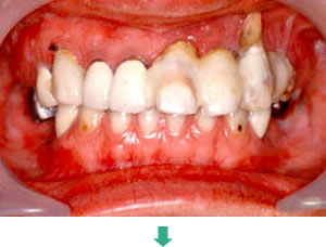 インプラント治療前