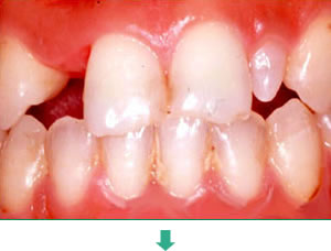 インプラント治療前