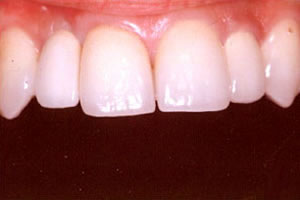 インプラント治療後