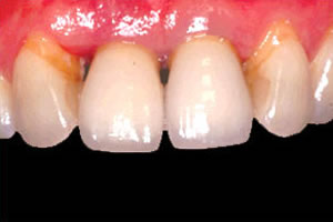 インプラント治療後