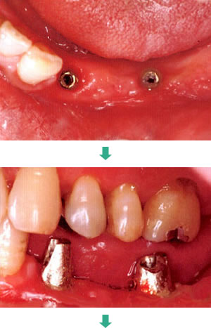 ブリッジタイプのインプラントを入れる