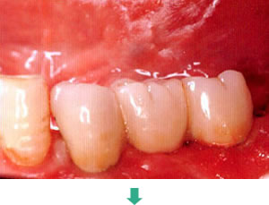 インプラント治療後