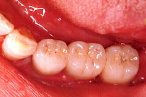 インプラント治療後