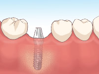 アバットメント