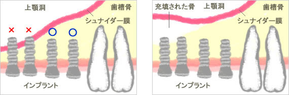サイナスリフト
