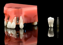 インプラント治療の基礎知識