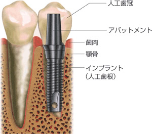 インプラントの構造