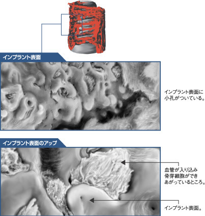 インプラント表面の構造