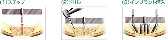 ALL-ON-4ガイドを使用してインプラントを正確に埋入