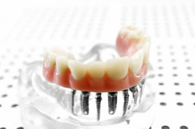 インプラントの寿命